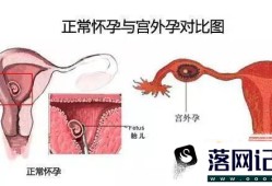 孕早期腹痛的鉴别诊断优质