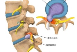 腰间盘突出症不花钱、最简单的治疗方式