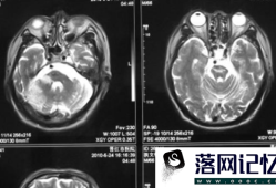 脑梗塞有哪些前兆优质