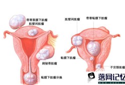 异位妊娠的鉴别诊断优质