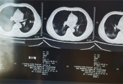 阳了怎么知道肺部是否感染