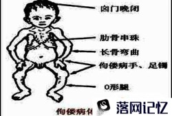 佝偻病与软骨病的区别优质