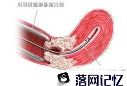 药流后有哪些情况需要清宫优质