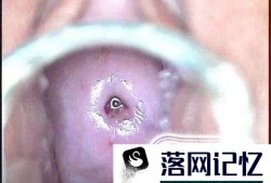 宫颈糜烂要怎么治疗？宫颈糜烂不治自己会好吗优质