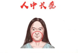 女人人中有痣可以点掉吗