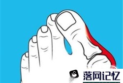 拇趾外翻怎么办优质