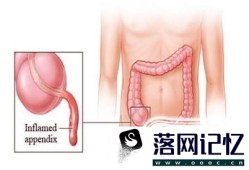 阑尾炎一定要做手术吗？优质