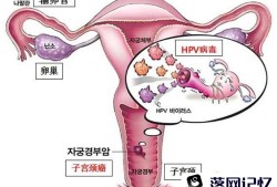 什么是宫颈癌 怎样预防宫颈癌优质