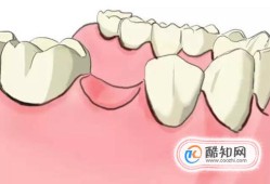 补牙牙套的相关问题优质