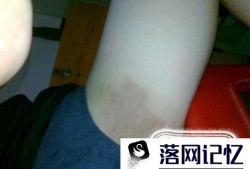 大腿内侧痒是什么病啊？最近痒得厉害总想抓优质