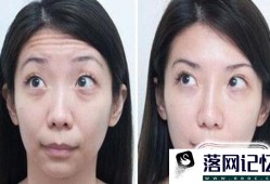 做去抬头纹价格贵吗优质