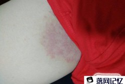 大腿内侧股癣怎么治？涂了很多药膏皮肤很黑？优质