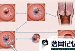 宫颈糜烂要怎么治疗？宫颈糜烂不治自己会好吗优质