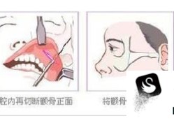 磨颧骨手术效果好不好？优质