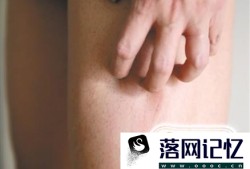 大腿内侧痒是什么病啊？最近痒得厉害总想抓优质