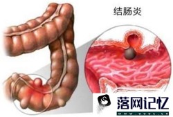 慢性结肠炎的症状是什么优质