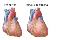 病毒性心肌炎是什么病