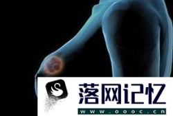 女性必知：乳腺癌早期五大症状优质