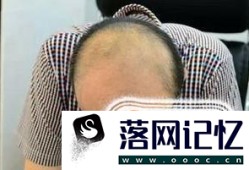 发际线高的人更容易秃头吗？为什么？优质