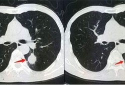 多地肺部CT检查需求激增有必要吗