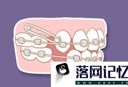 牙齿矫正改变我们脸型的步骤优质