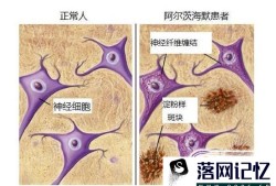 盘点阿尔兹海默症的十大早期症状优质