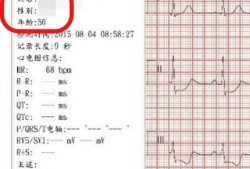 解读体检报告之心电图优质