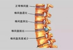 腰间盘突出症不花钱、最简单的治疗方式