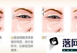 伊维兰去鱼尾纹手术效果好不好？优质