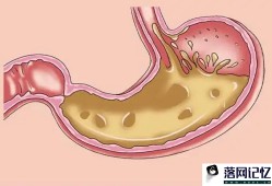胃酸多怎么调理较好优质