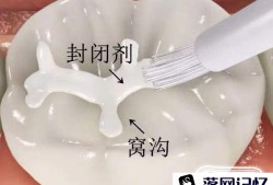 孩子做窝沟封闭有必要吗？优质