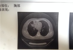 多地肺部CT检查需求激增有必要吗