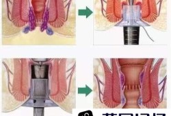 痔疮外痔肉球怎么消除用什么药优质