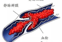 长期久坐会得肺栓噻？优质