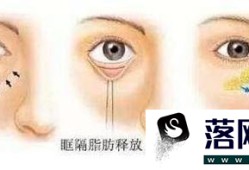 做眶隔脂肪释放消除肿眼泡手术麻醉方式是什么？优质