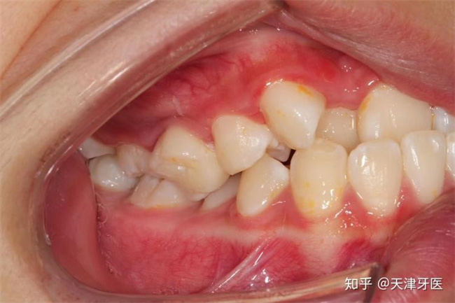 从牙齿看人的性格和财运  第5张