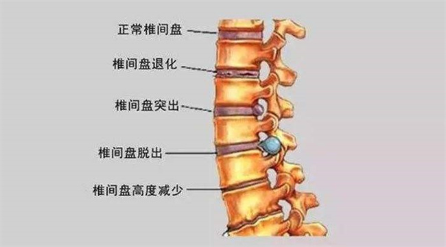 腰间盘突出症不花钱、最简单的治疗方式  第1张