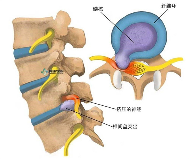 腰间盘突出症不花钱、最简单的治疗方式  第2张