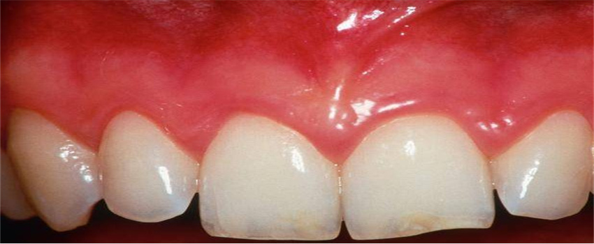 牙齿出血是什么个状况  第1张
