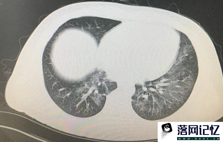 新冠感染之后肺会变成什么样优质  第1张