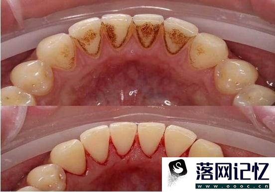 合理洗牙对牙齿有伤害吗优质  第1张