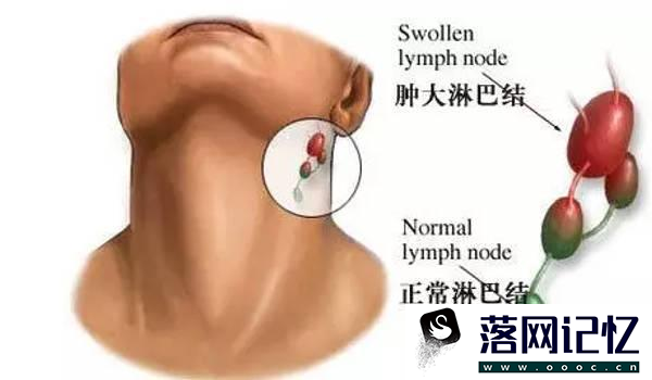 急性淋巴结炎怎样得的优质  第1张