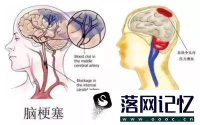 脑梗的症状都有哪些前期症状优质  第4张