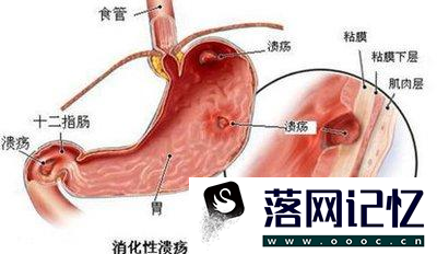 胃溃疡症状表现有哪些优质  第4张