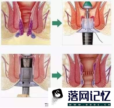 痔疮外痔肉球怎么消除用什么药优质  第1张