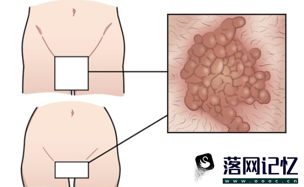 阴茎根部尖锐湿疣如何治疗优质  第2张