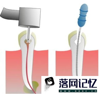 如何判断自己是否需要做根管治疗优质  第1张