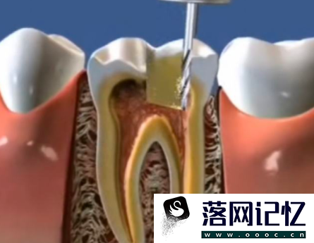 如何判断自己是否需要做根管治疗优质  第2张