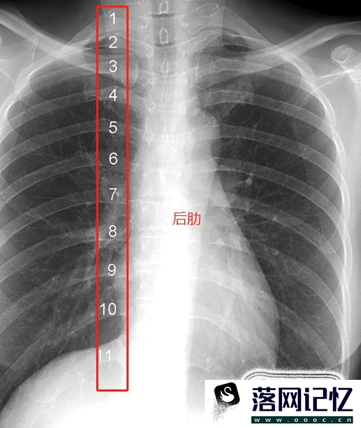 教你怎么看正常的胸片优质  第3张