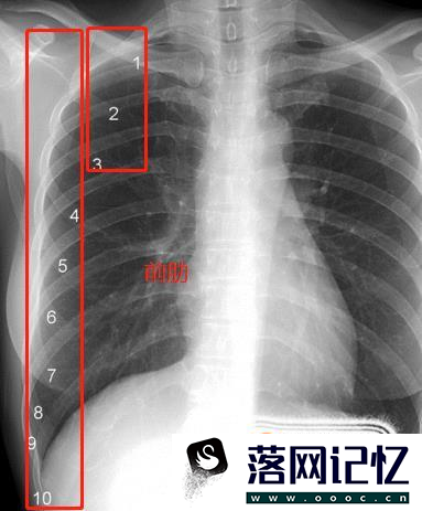 教你怎么看正常的胸片优质  第4张